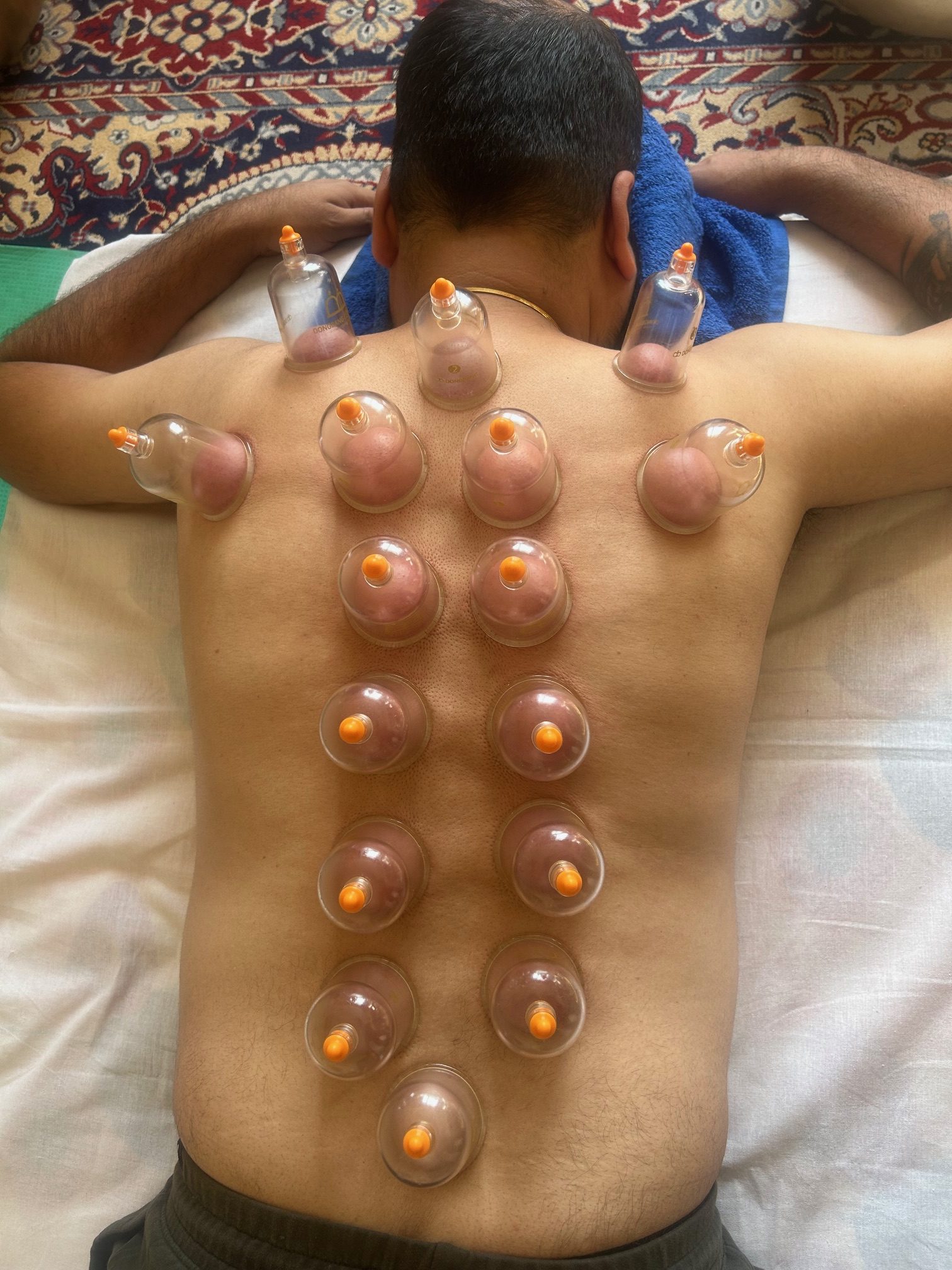 cupping-therapy