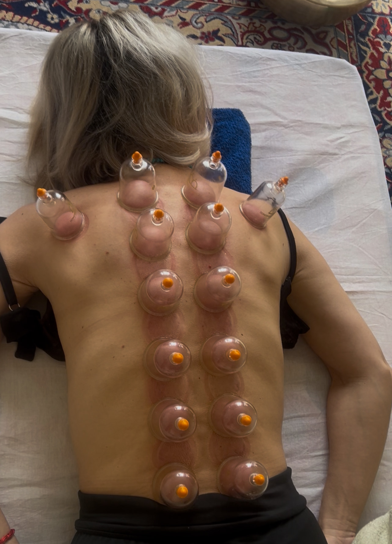 cupping